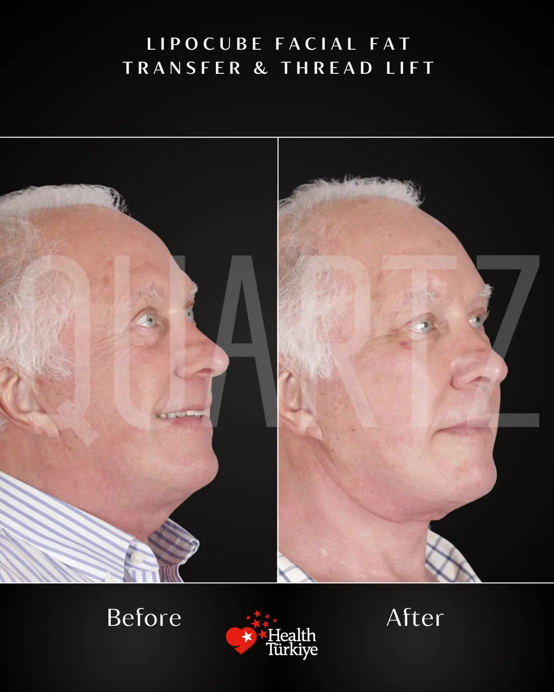 Before & After: Facial Fat Transfer New Result 5